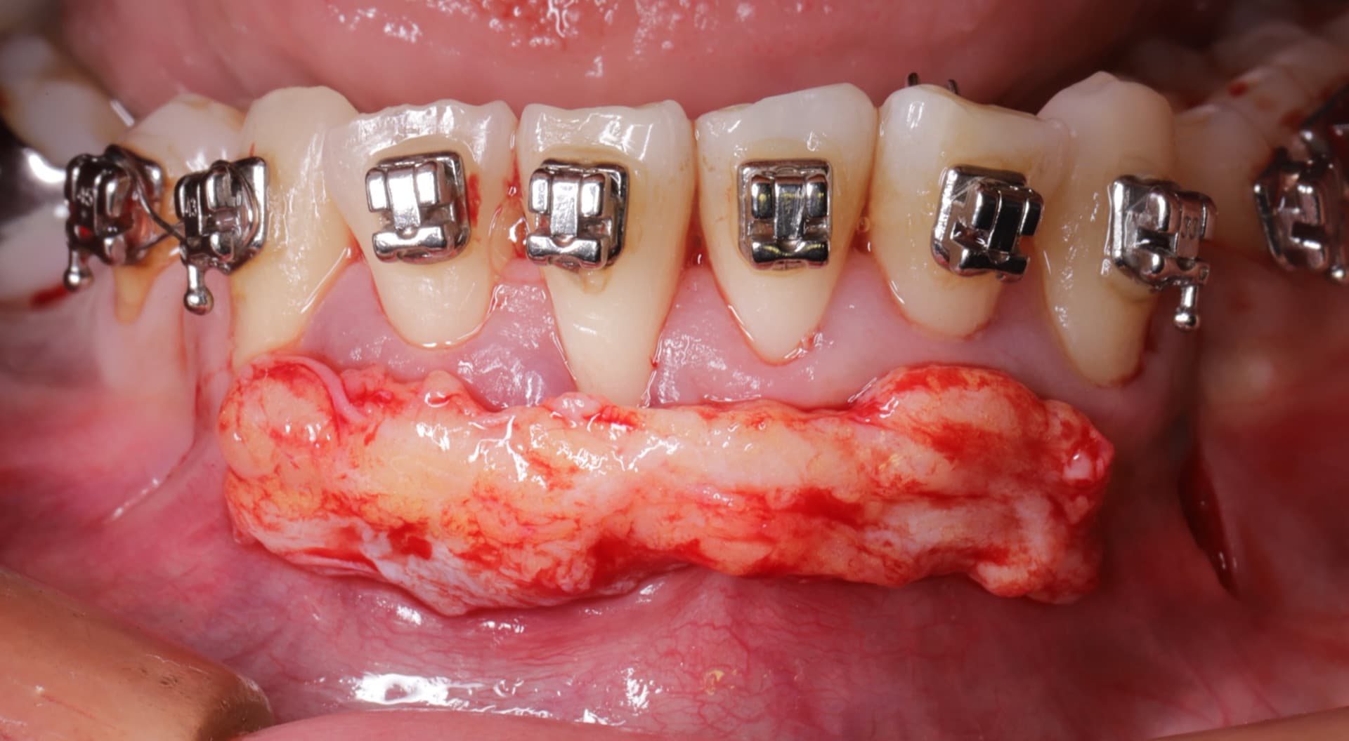 Injerto de tejido conectivo para recubrimiento radicular — cirugía plástica periodontal, PerioPlastic
