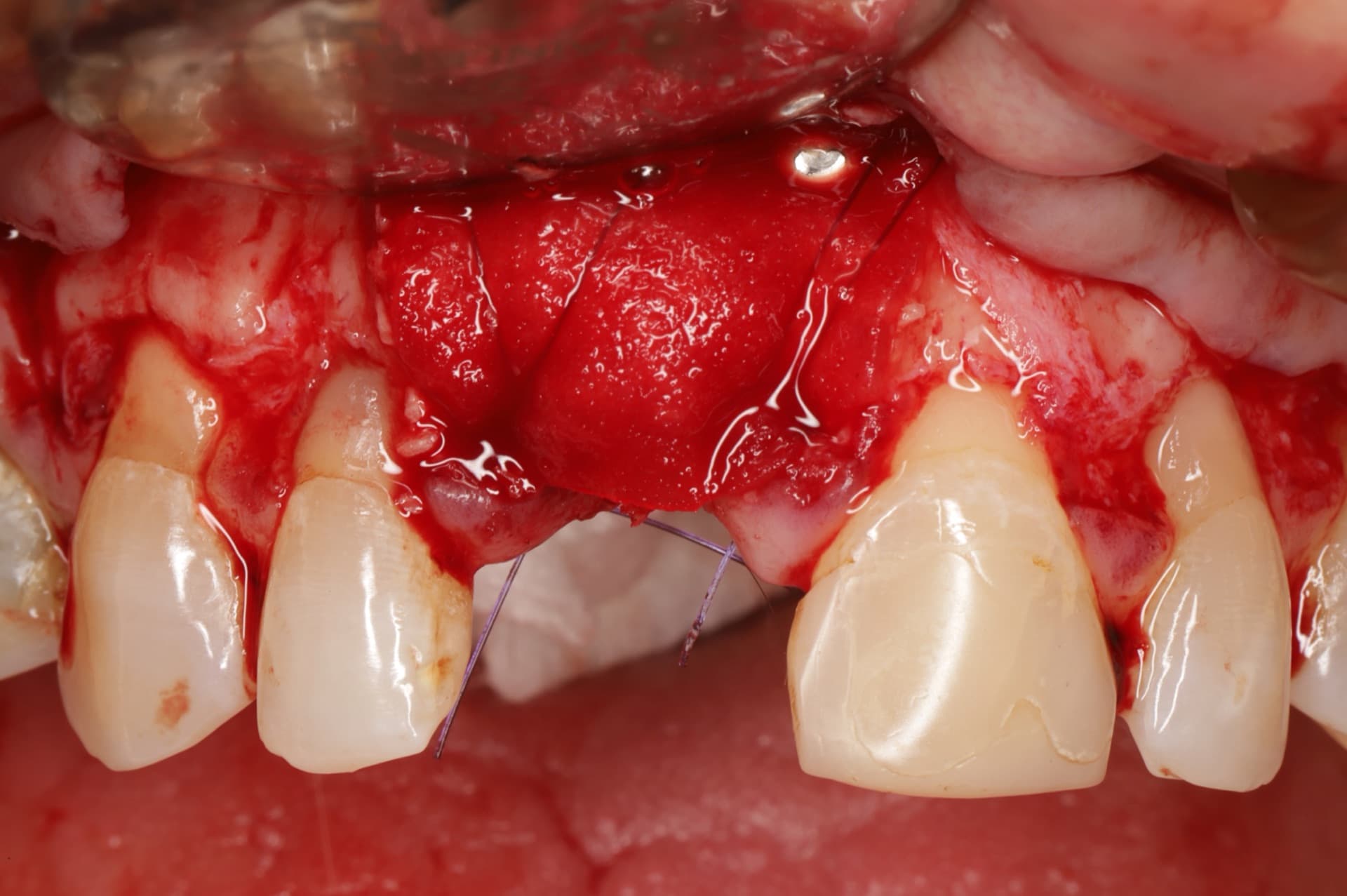 Regeneración ósea guiada con sausage technique — Dr. Pablo Urrutia, PerioPlastic