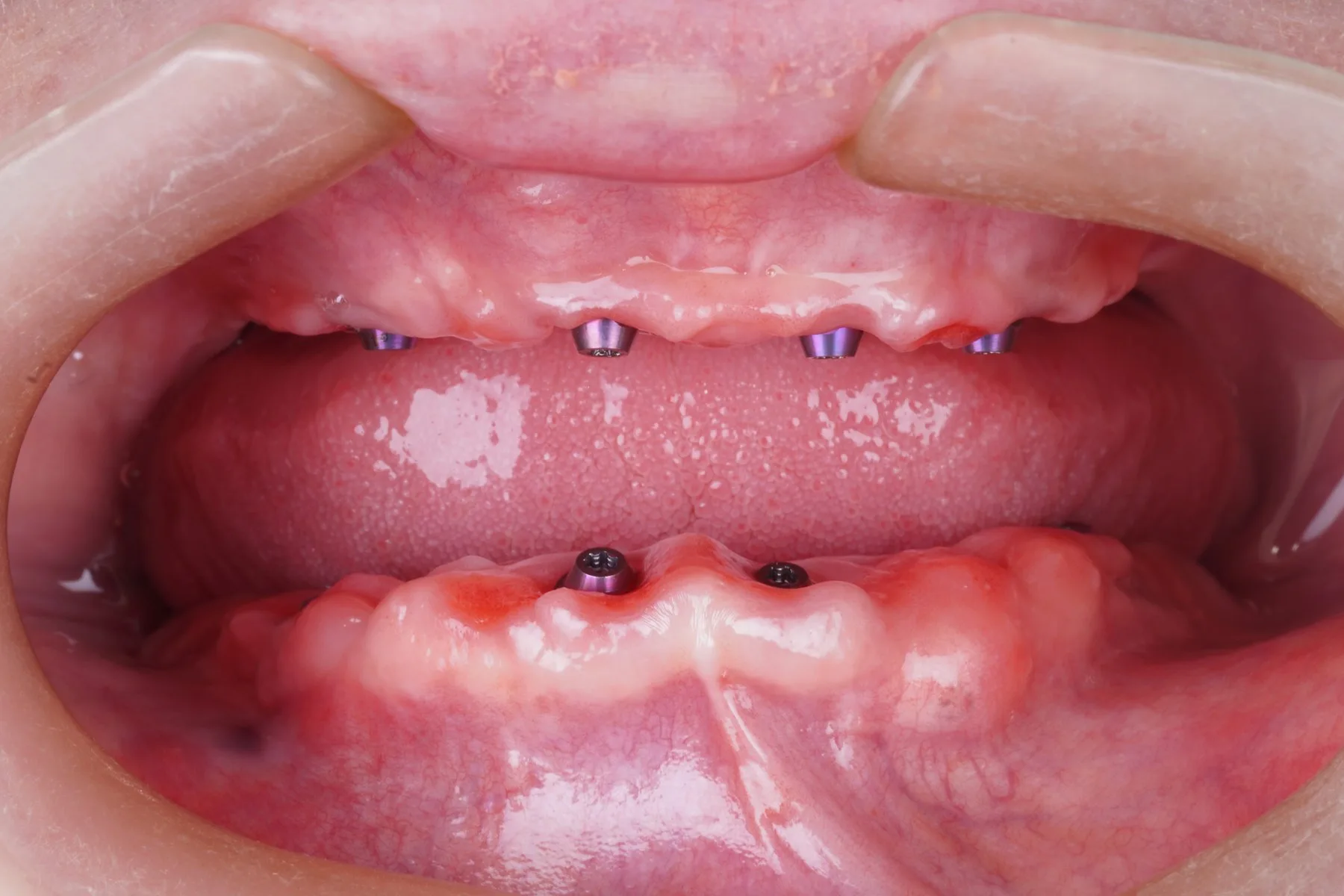 Arquitectura gingival tras carga inmediata