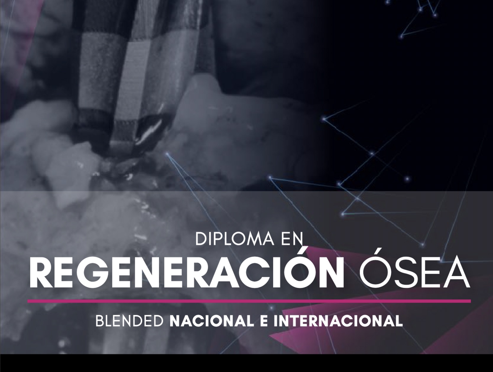 Regeneración Ósea Guiada