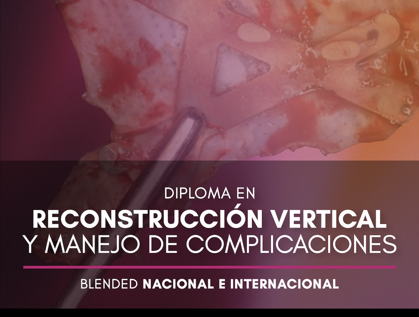 ROG Vertical y Complicaciones