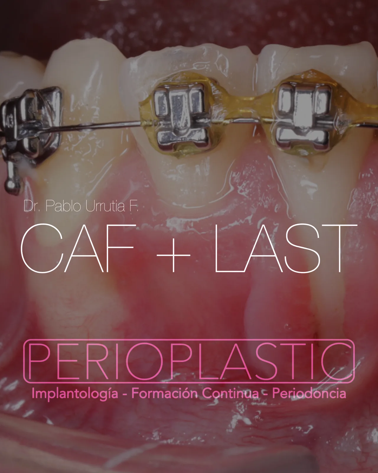 CAF + LAST — Recubrimiento radicular con cambio de biotipo