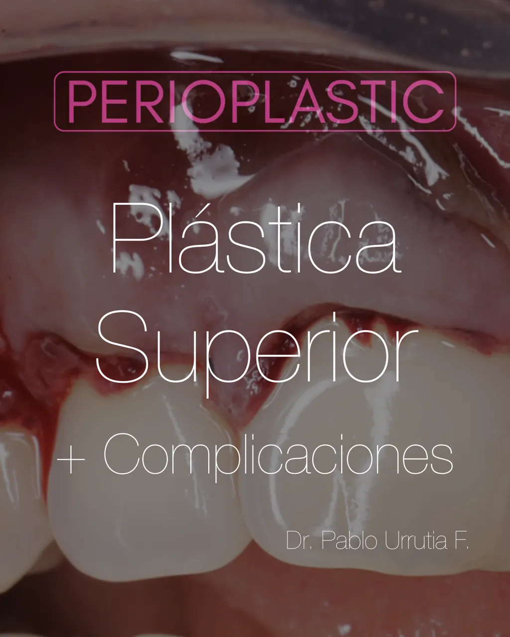 Majin Técnique — Full-Arch Case with an Optimized Connective Tissue Graft
