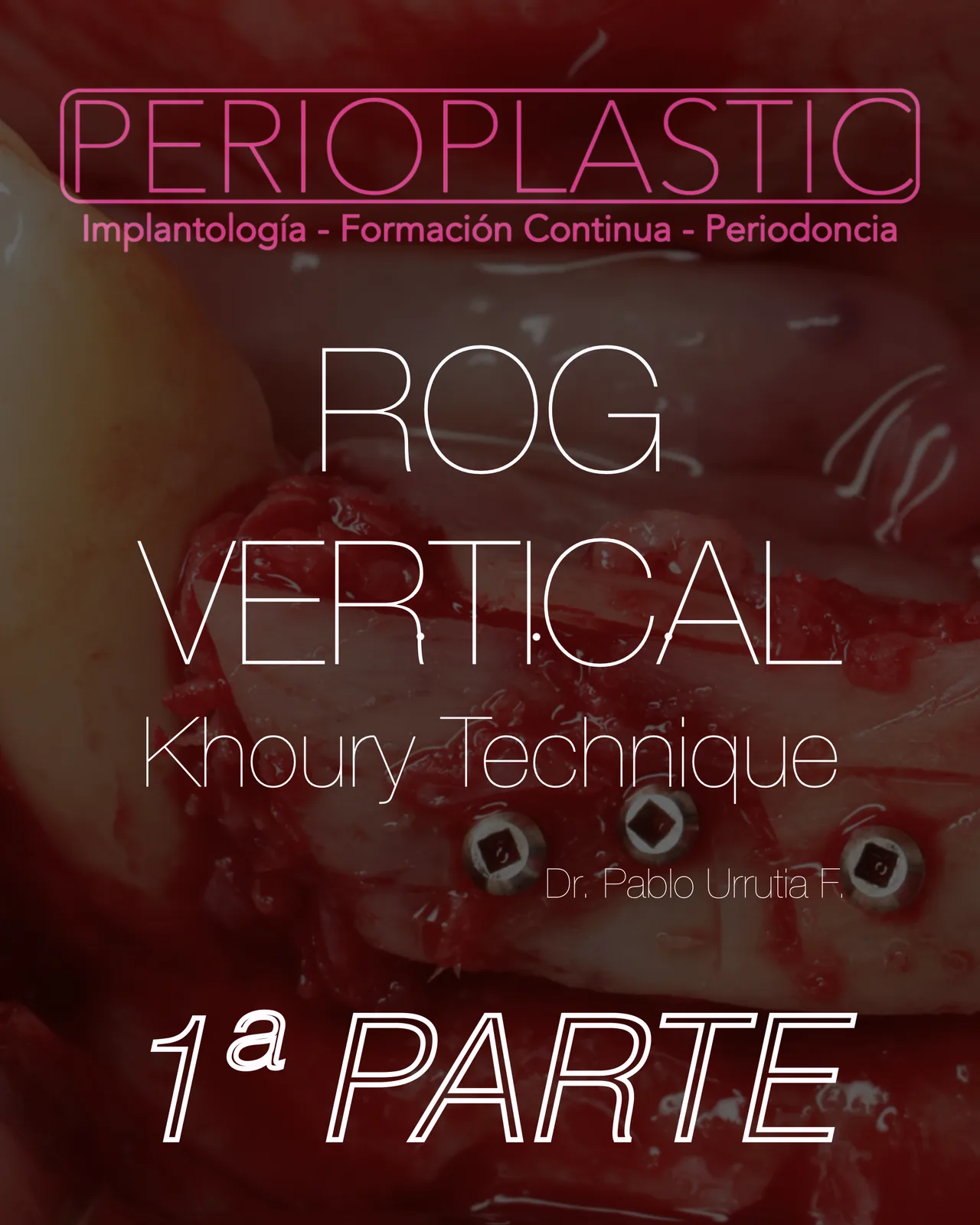 ROG Vertical — Técnica Khoury · 1ª Parte