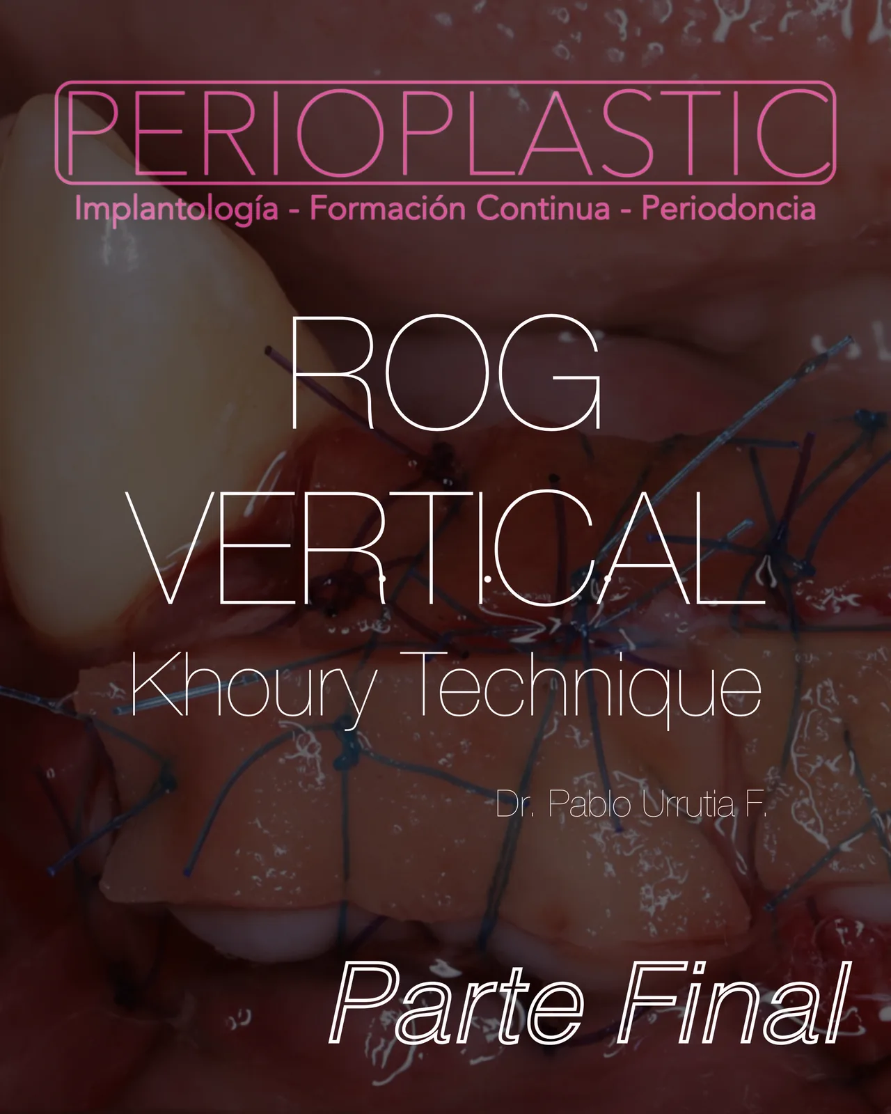 ROG Vertical — Técnica Khoury · 3ª Parte (Final)
